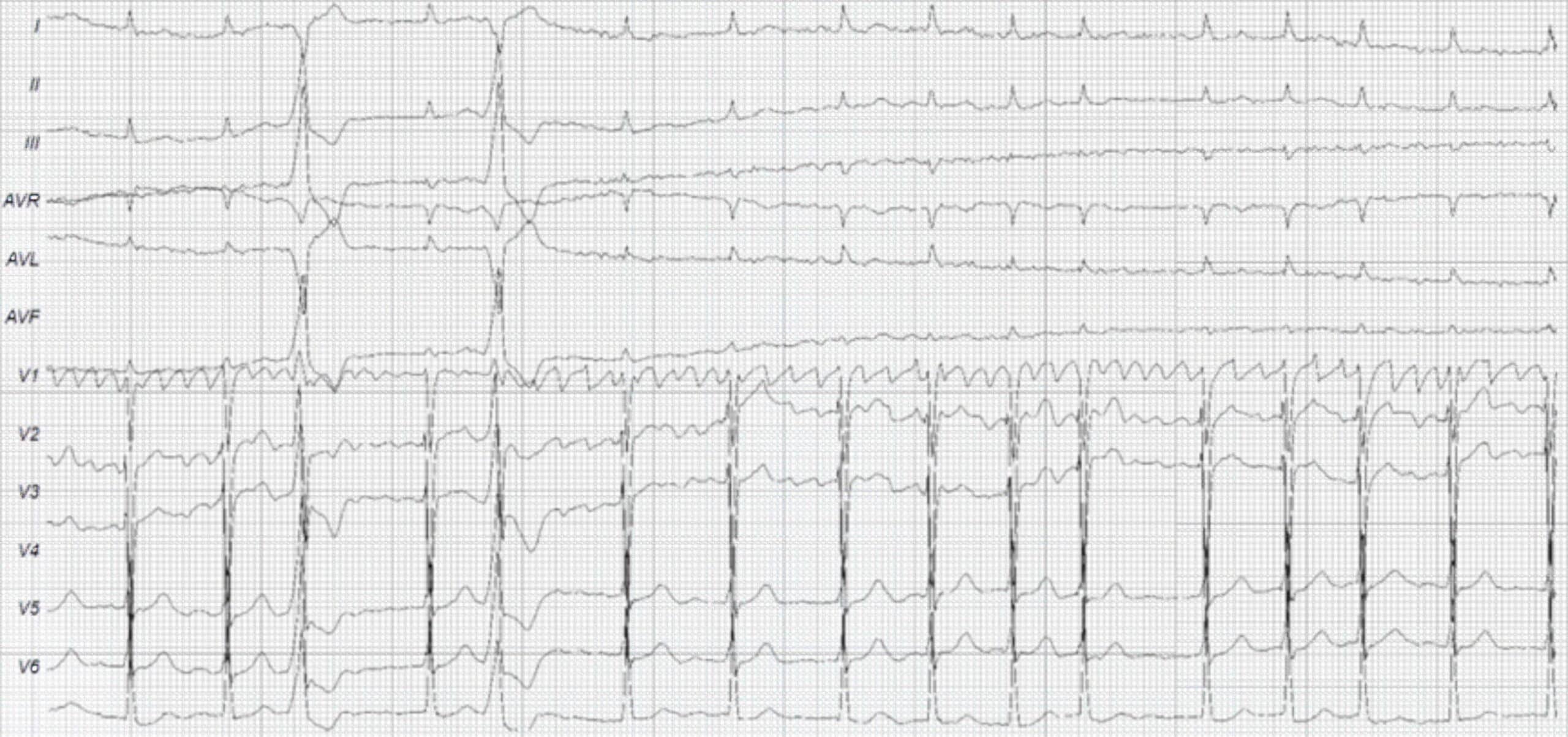79-year-old woman with mitral valve disease ECG.