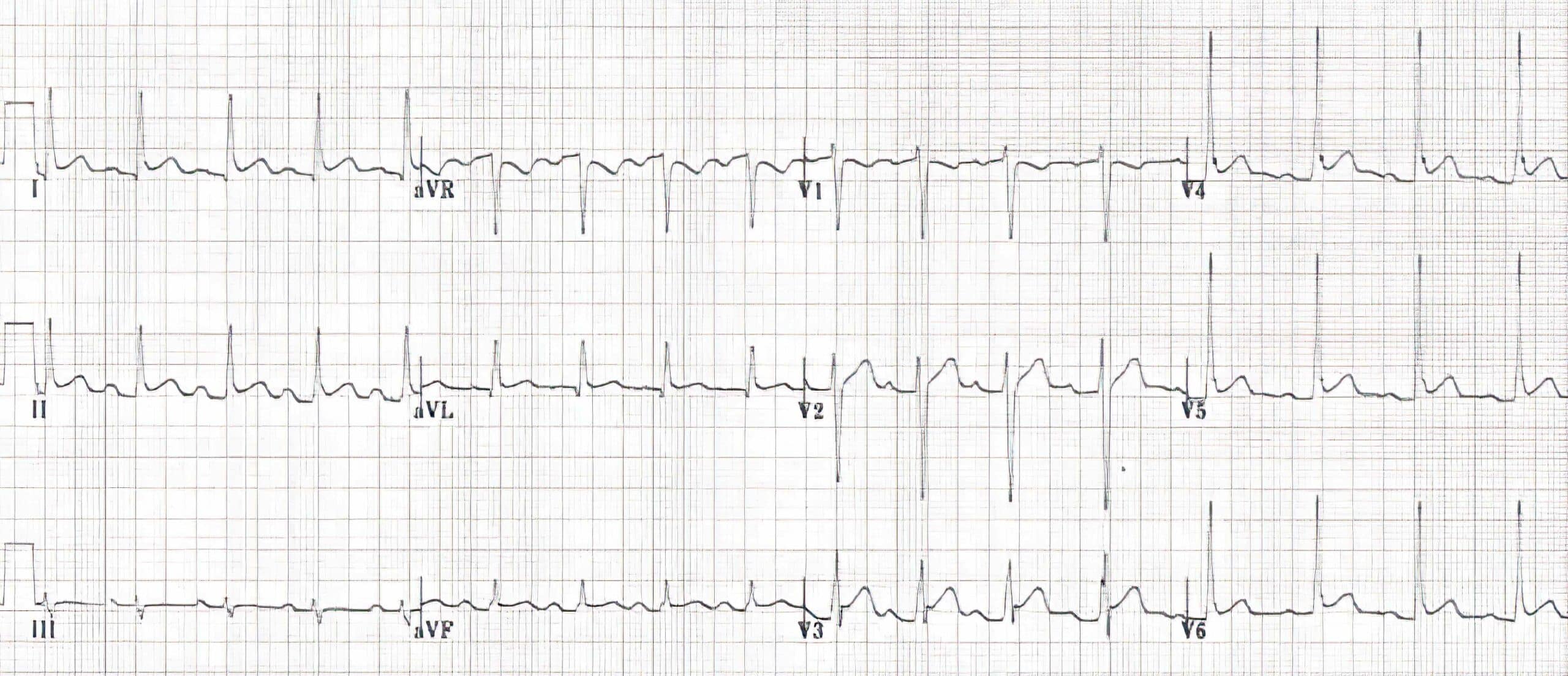 Acute pericarditis ECG rhythms.