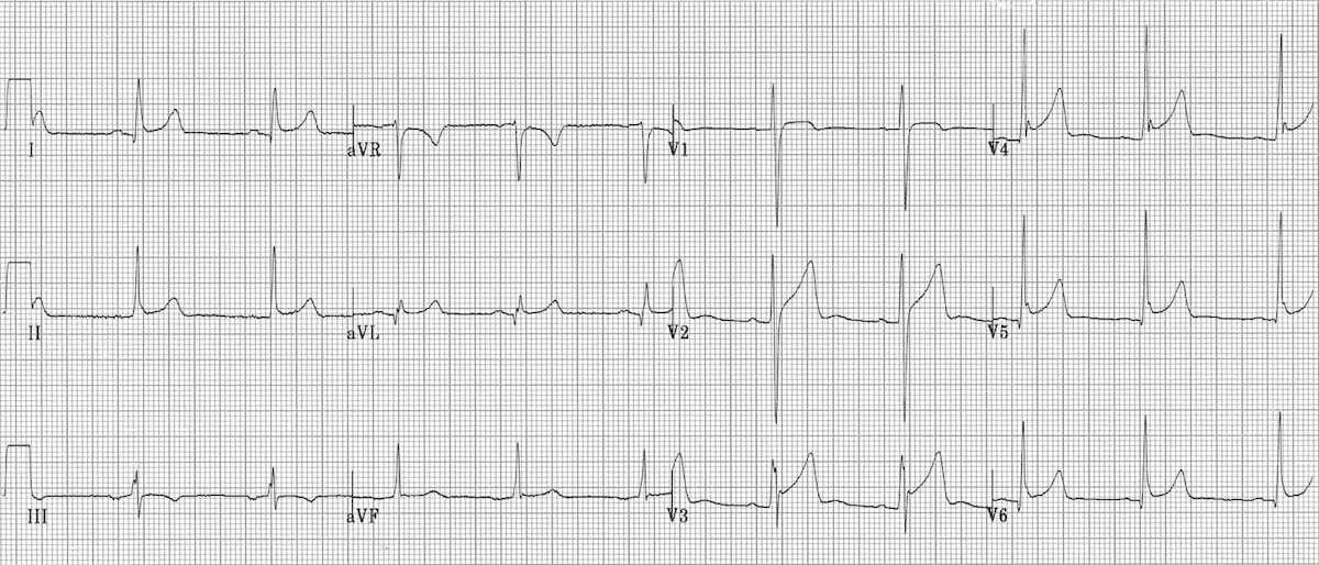 Benign early repolarization identified by widespread minor ST elevation and stork leg sign ECG.