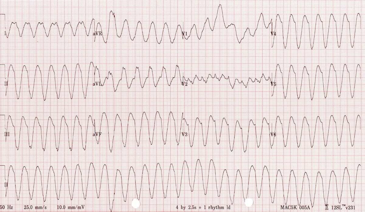 Classic monomorphic ventricular tachycardia ECG.