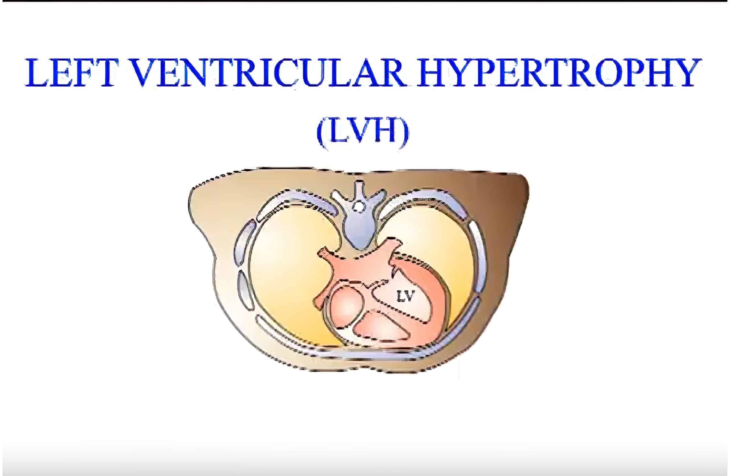 ECG findings in LVH Sokolow-Lyon criteria video.