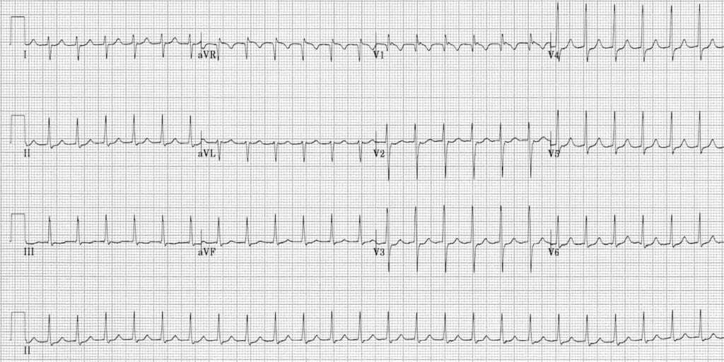 ECG Typical Slow Fast AVNRT ECG representing typical slow-fast AVNRT.