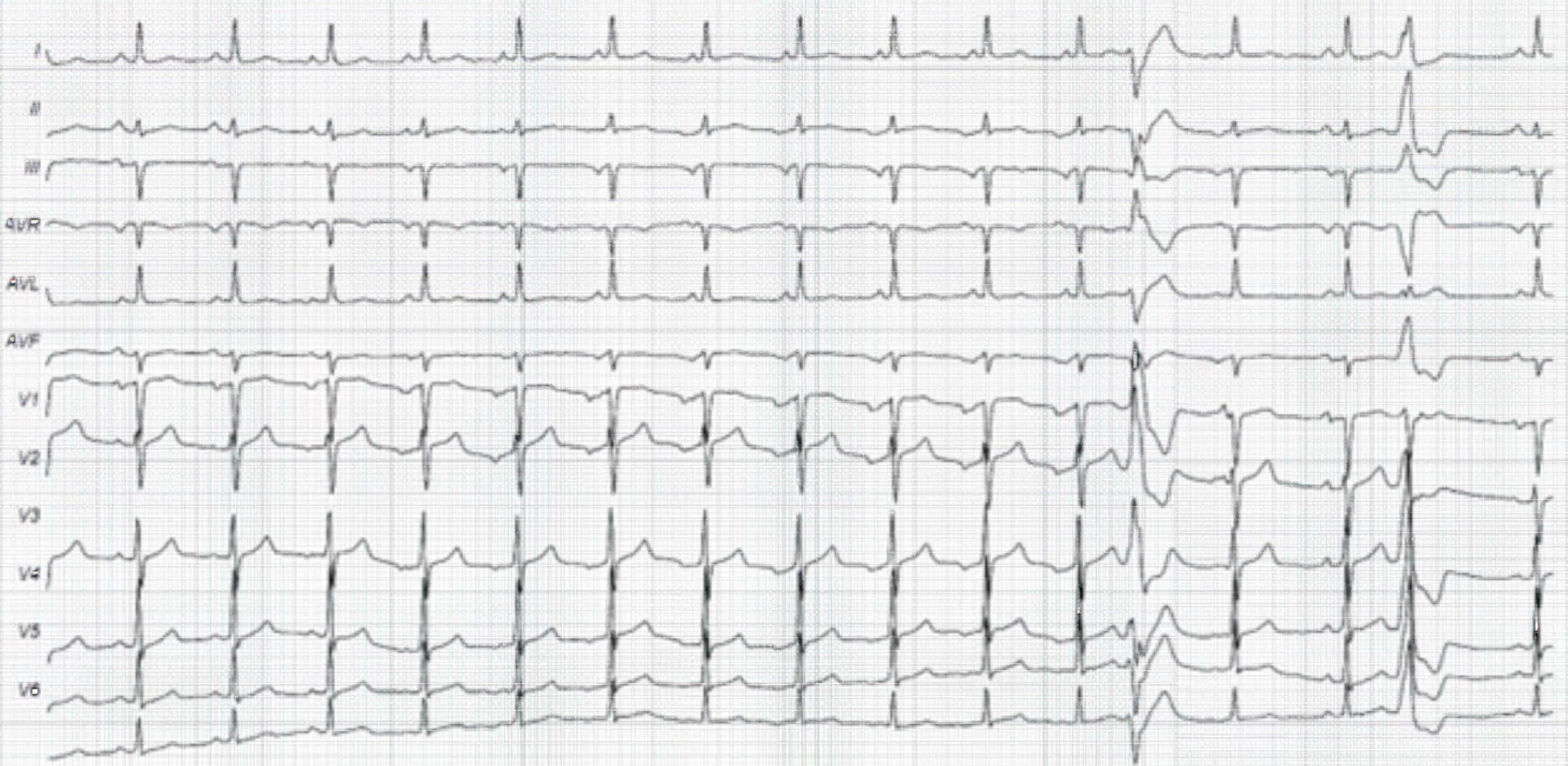 Polymorphic premature ventricular complexes ECG.
