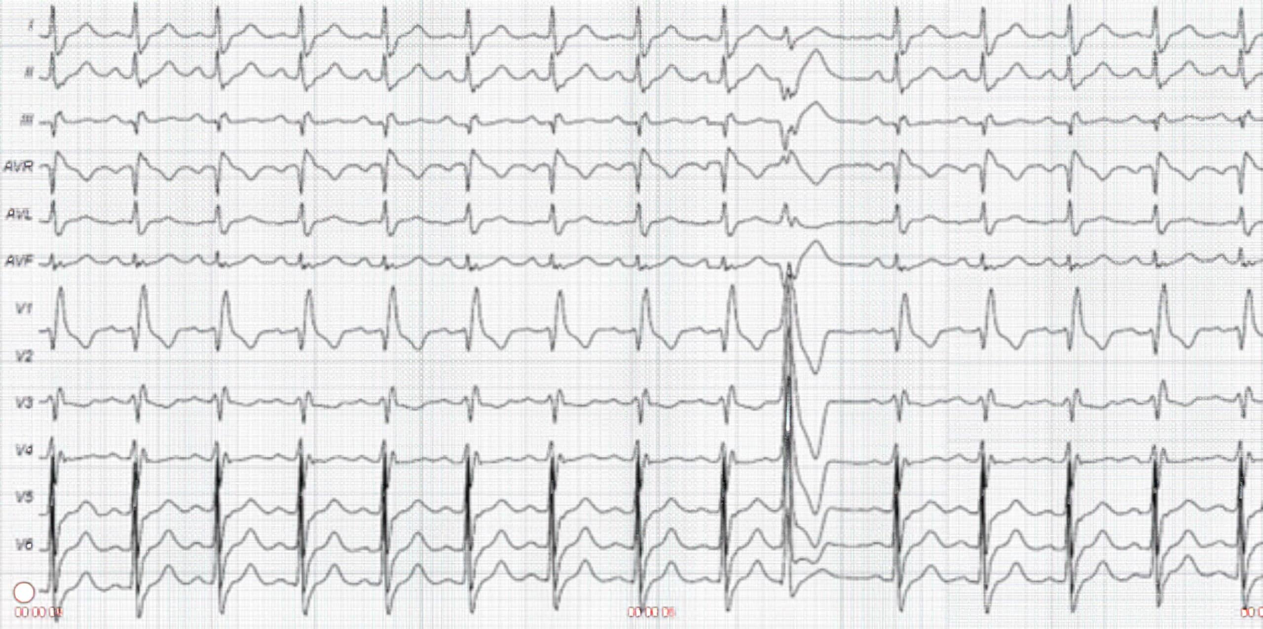 Premature ventricular contraction with RBBB pattern.
