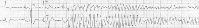 Torsades de Pointes.