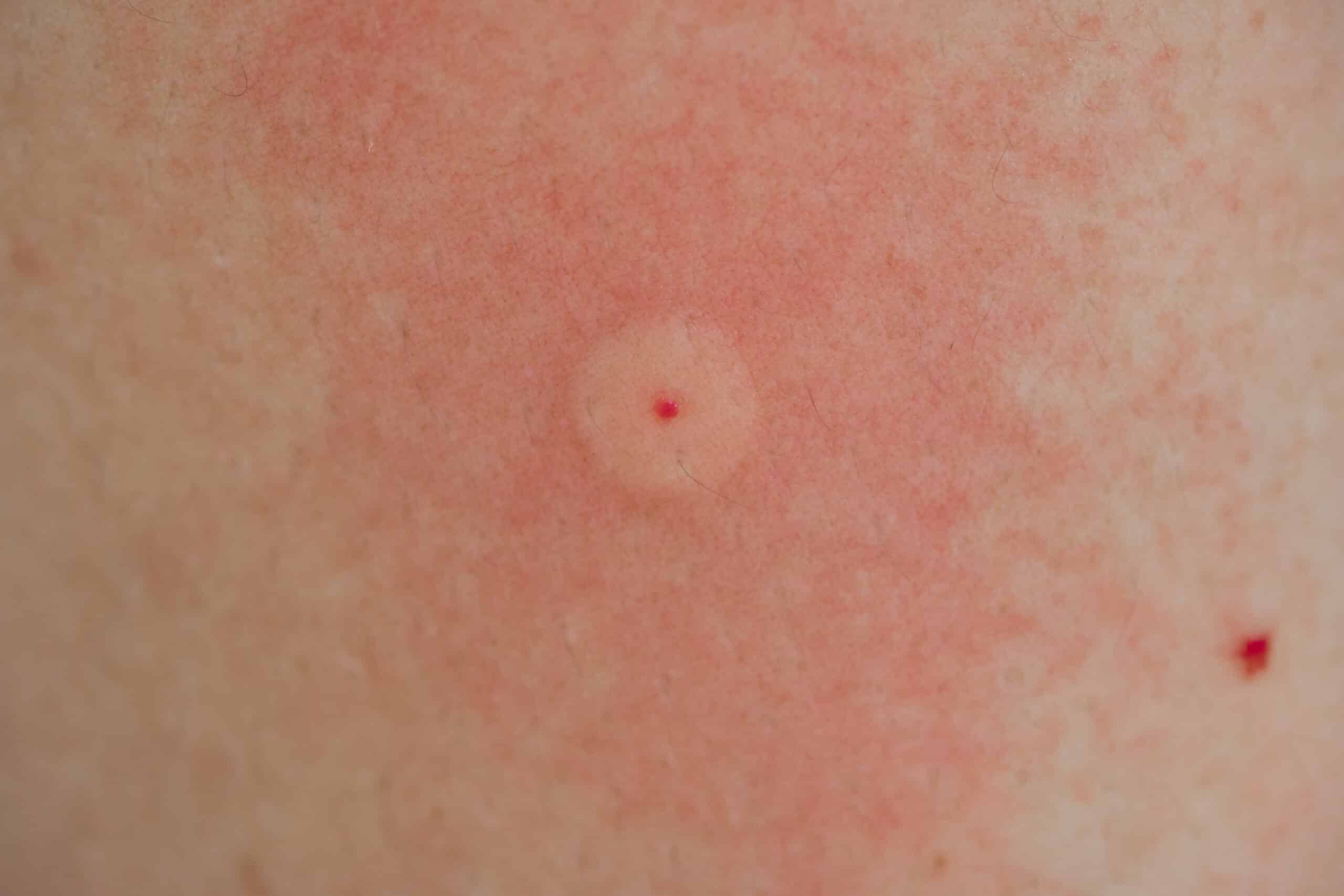 Bee sting with localized skin reaction.