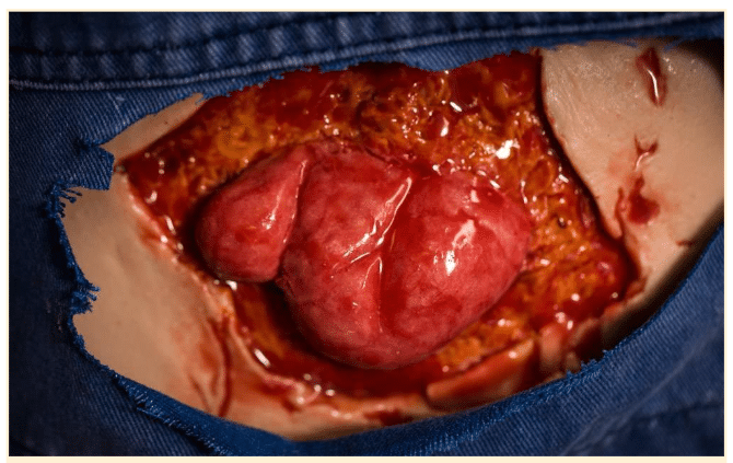 Evisceration.