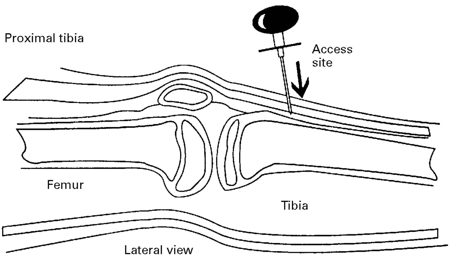 Drawing of an intraosseous needle entering just below the knee.