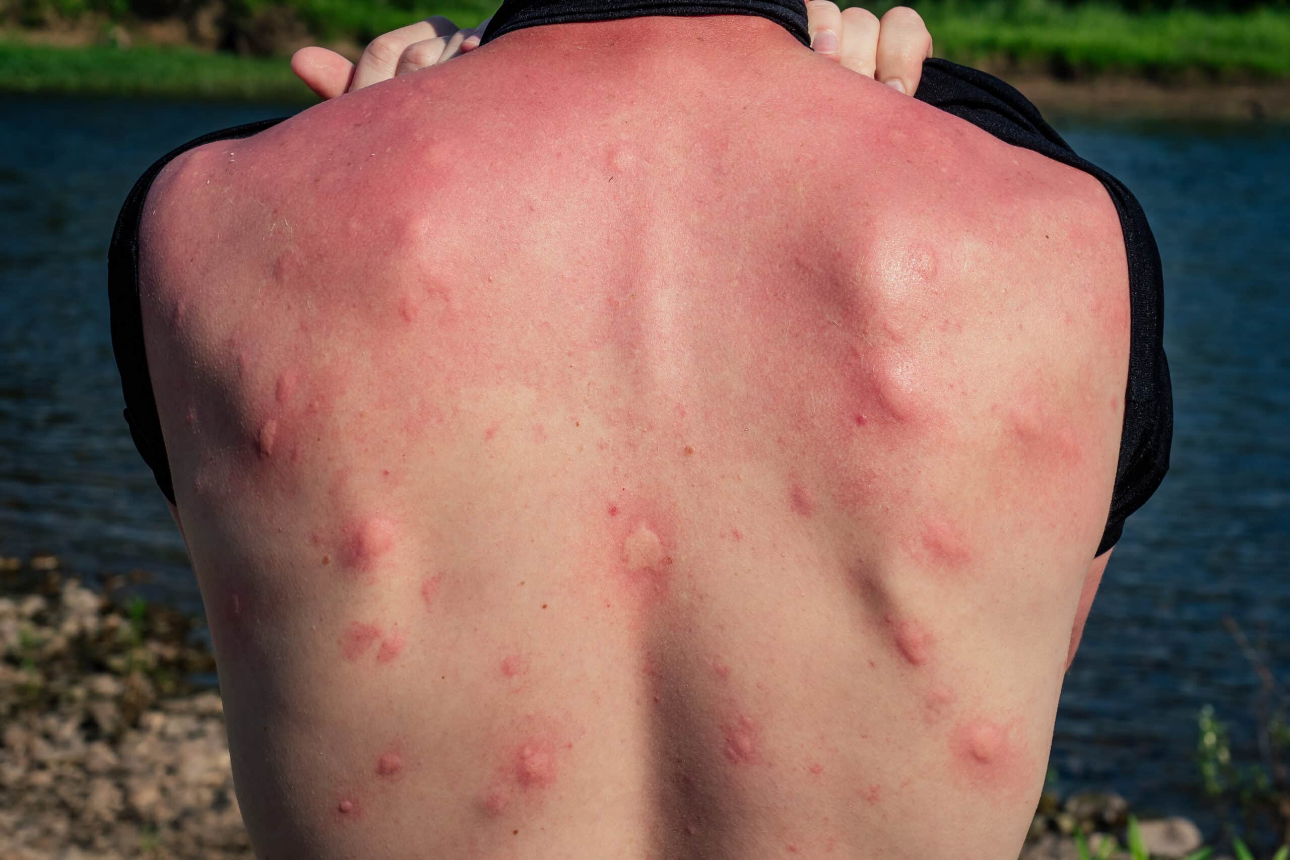 Papular urticaria from insect bites.