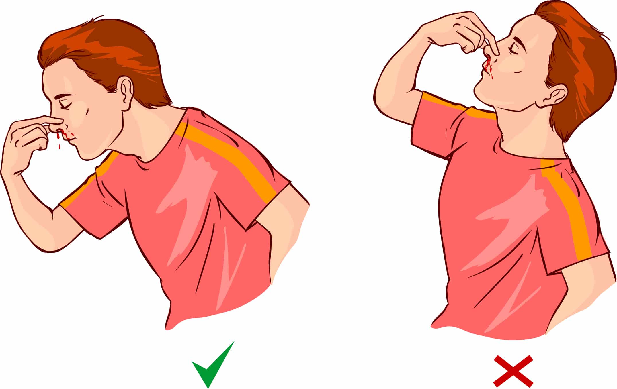 Proper positioning for nosebleeds is lean forward.