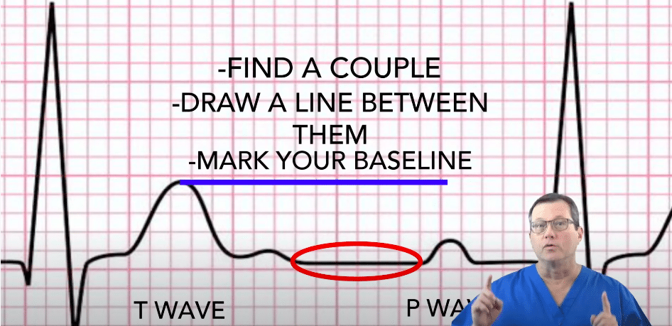 ST-Segment Elevation: Definition, ECG Criteria, and Clinical Significance