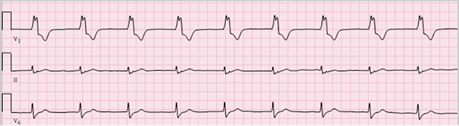 dioventricular rhythm - ECG tracing.