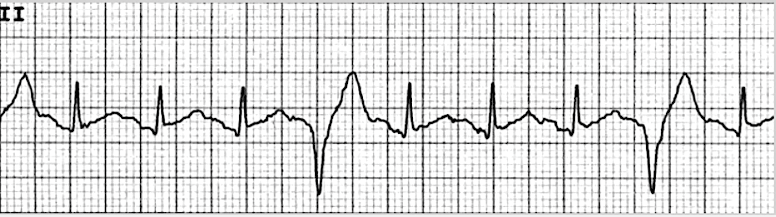 Quadrigeminy – ECG tracing.