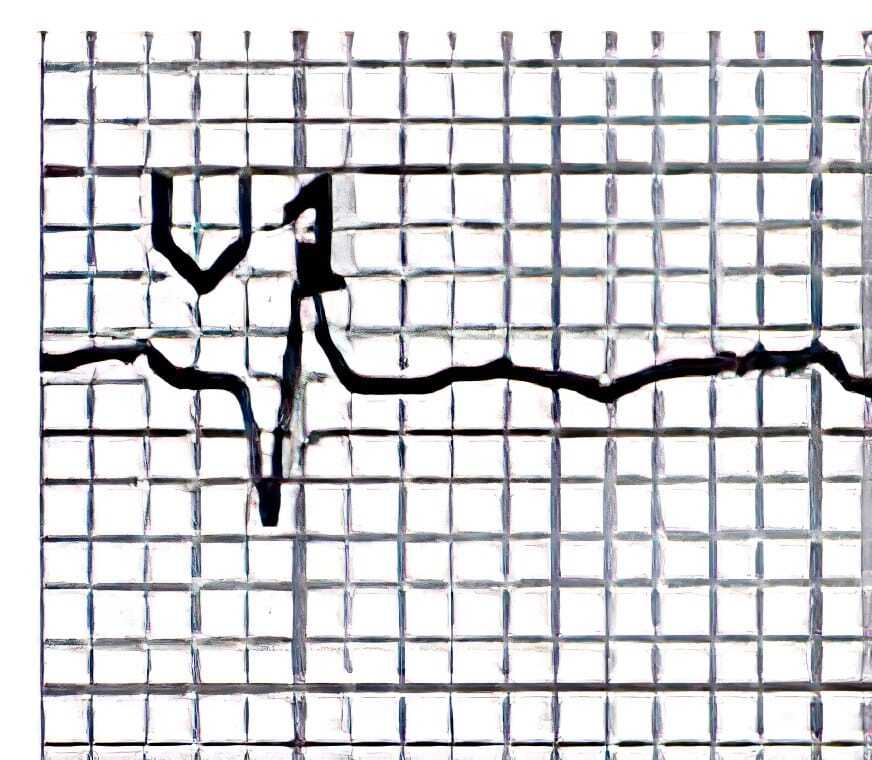 12-lead ECG of 46-year-old woman with severe mitral stenosis and tricuspid regurgitation.