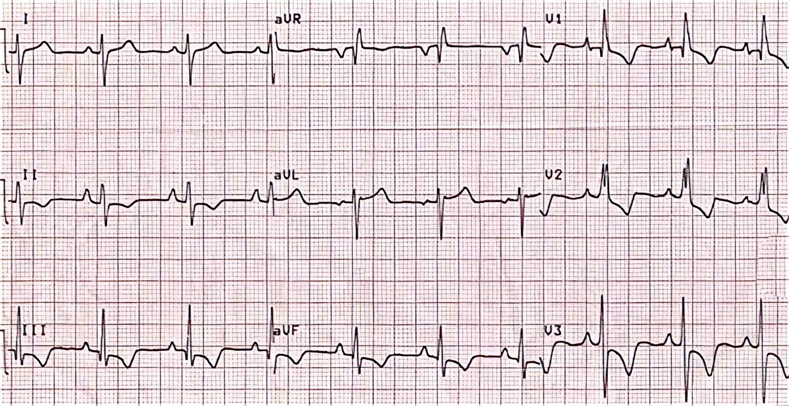12-lead ECG of 52-year-old woman with atrial septal defect.