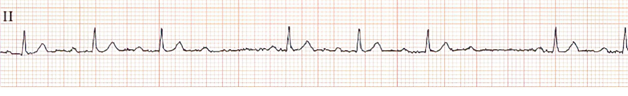 71-year-old man with second-degree AV Block ECG.