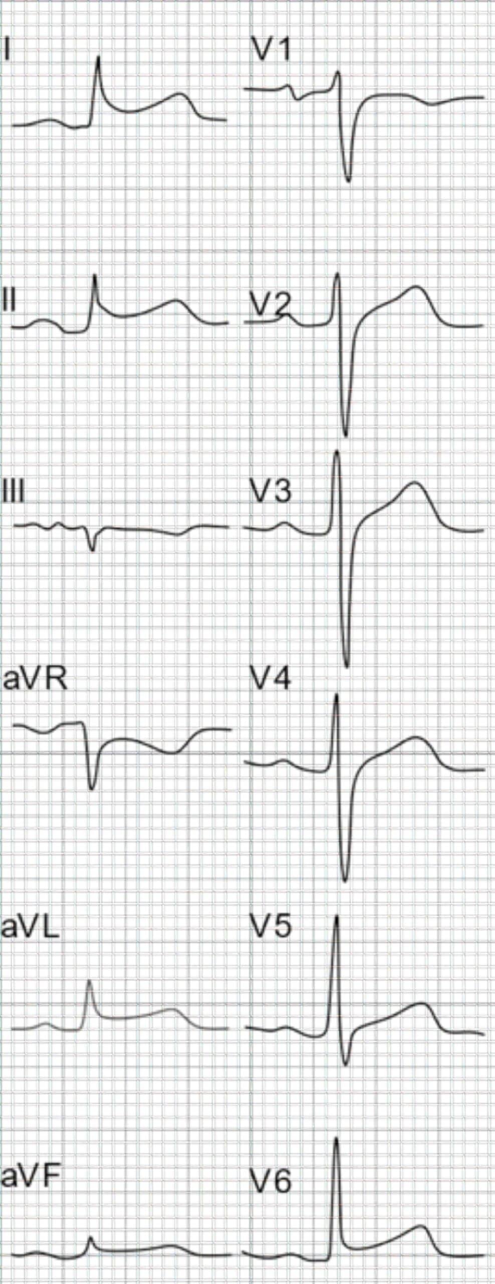 72-year-old man with pericardial effusion ECG.