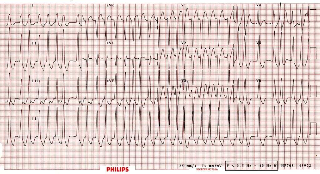 Atrial fibrillation in Wolff-Parkinson-White syndrome ECG.