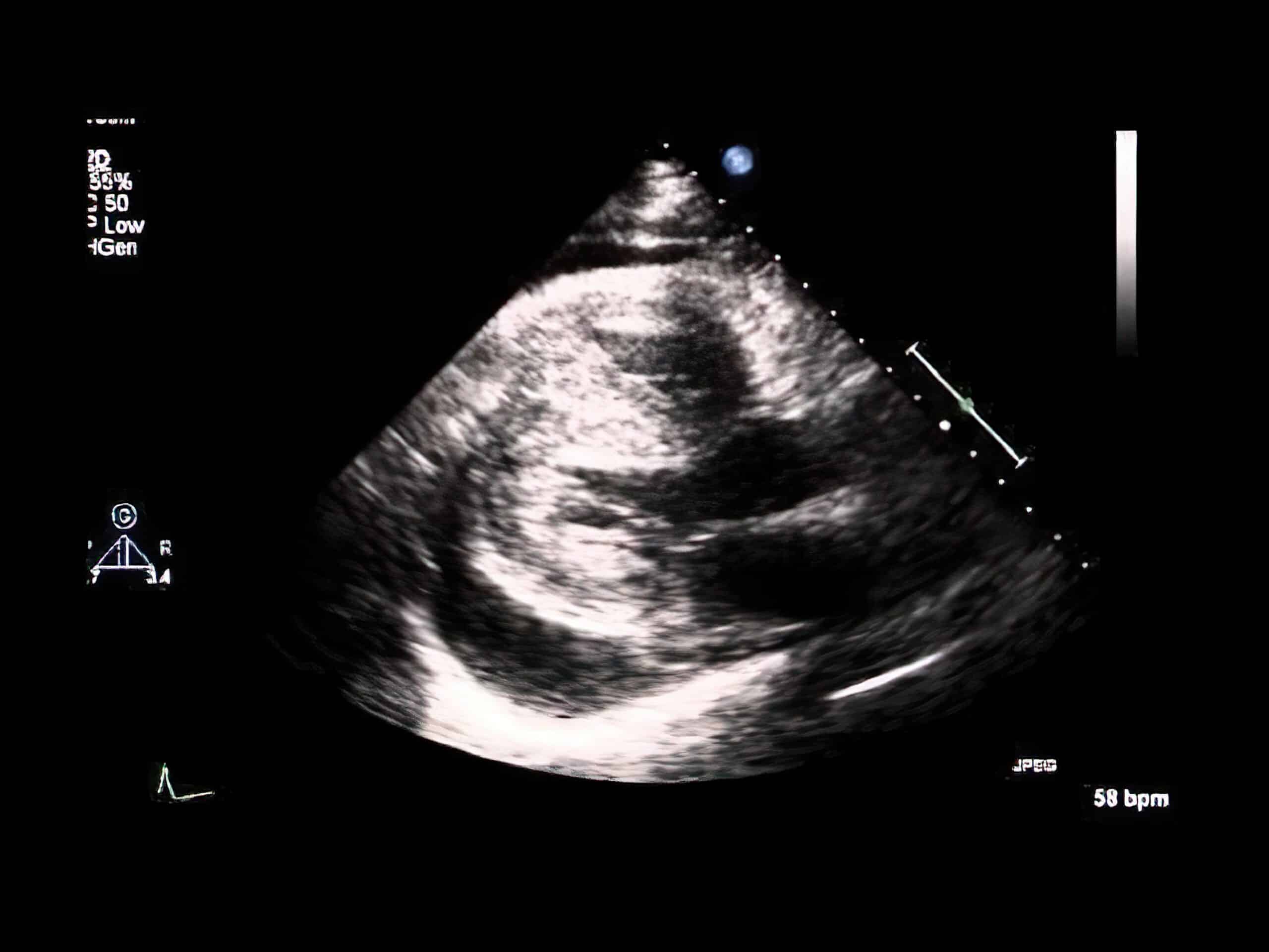 Biventricular hypertrophy echocardiogram.