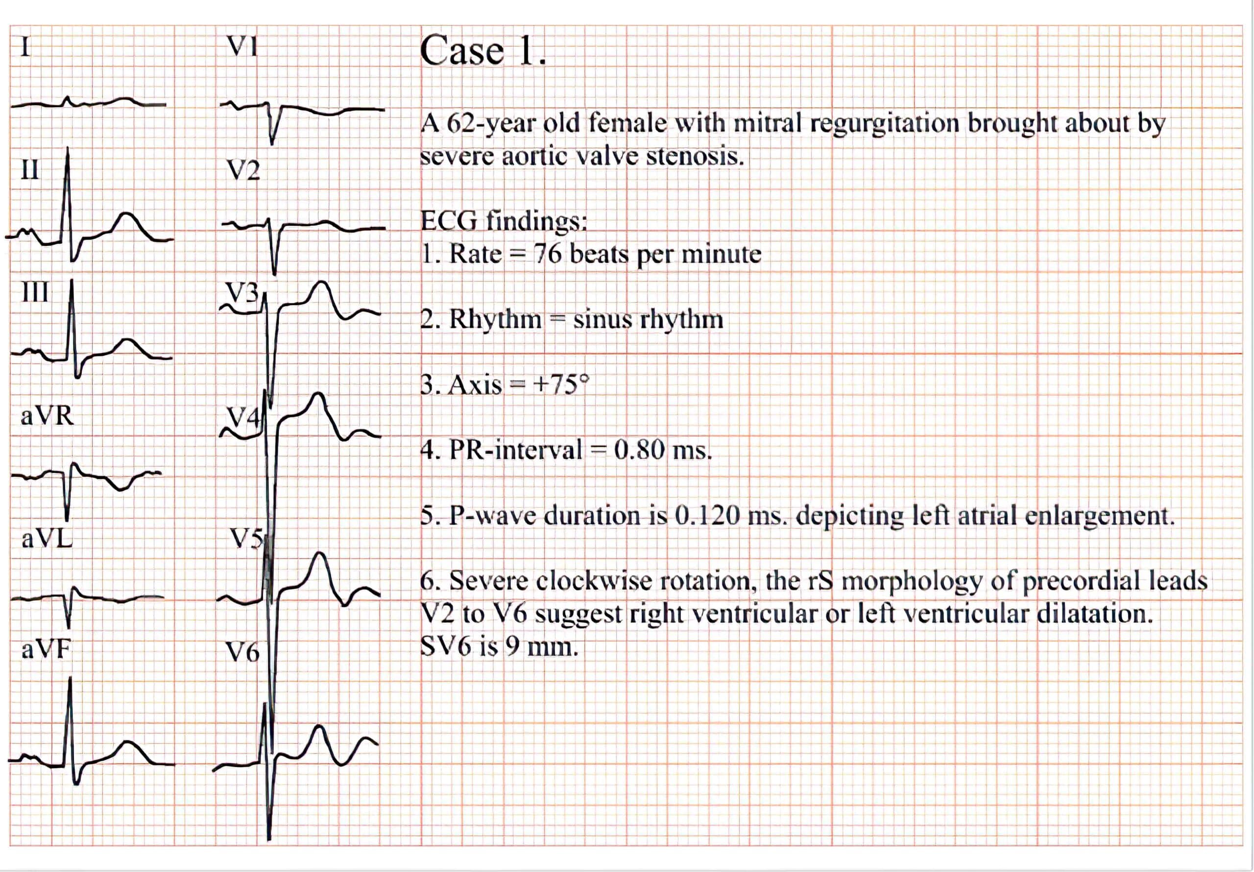 Case 1 ECG.