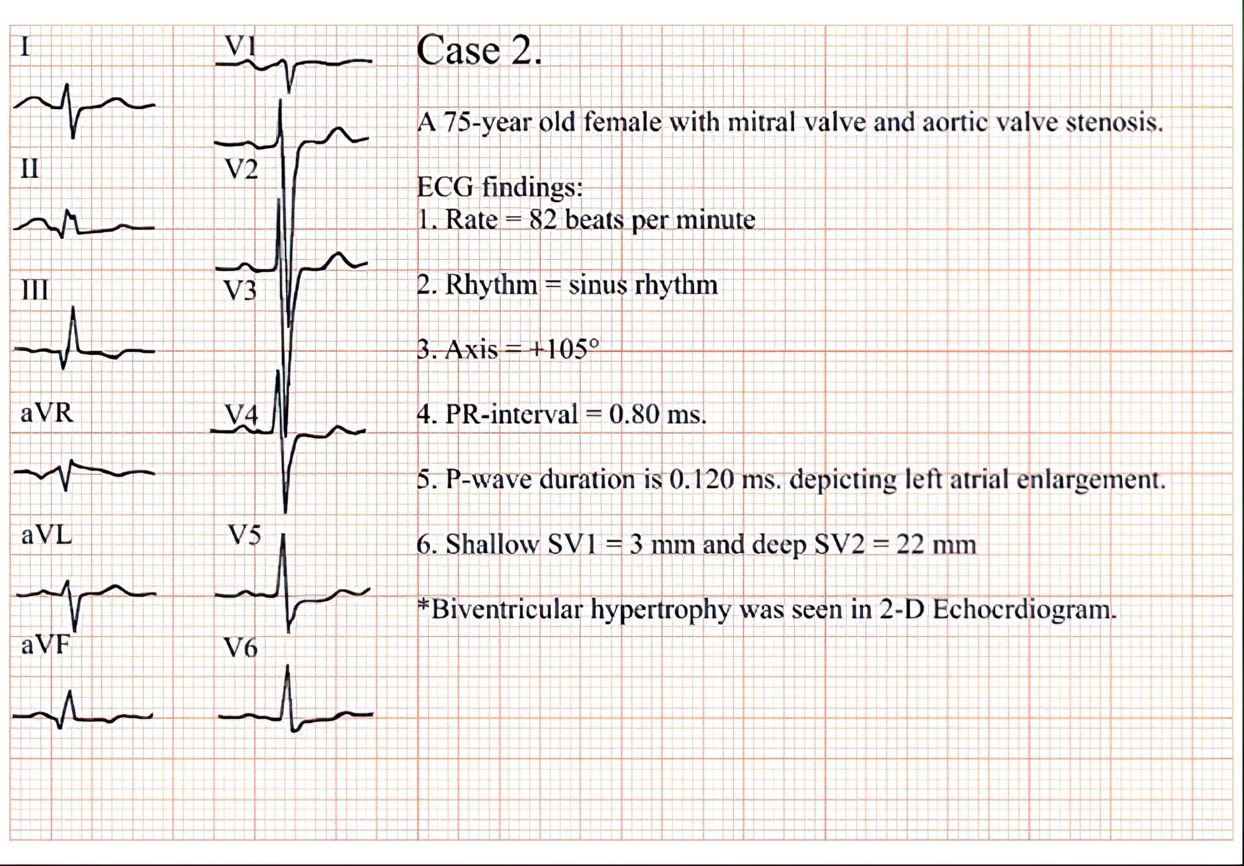 Case 2 ECG.