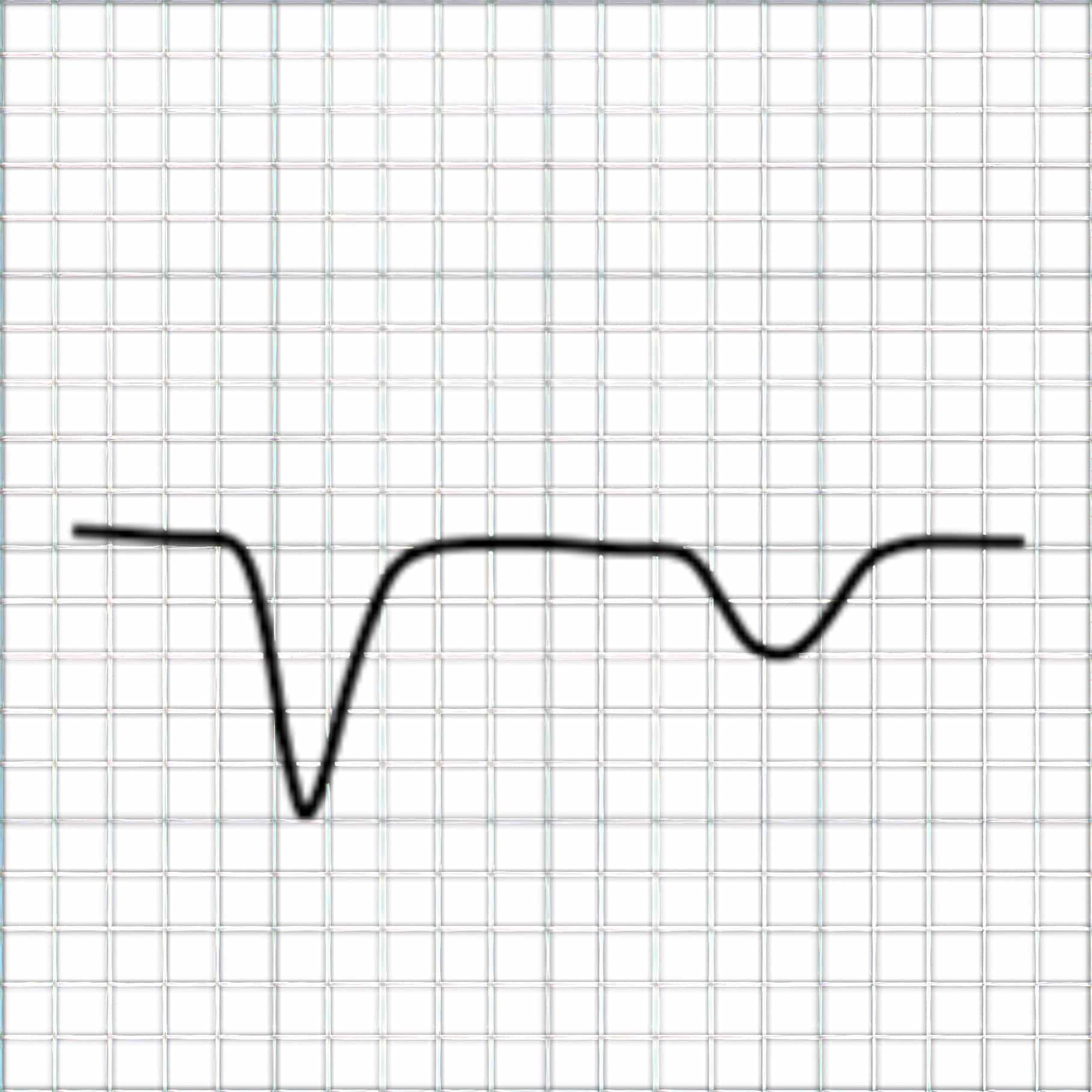 Chronic MI depicted by broad QS wave ECG.