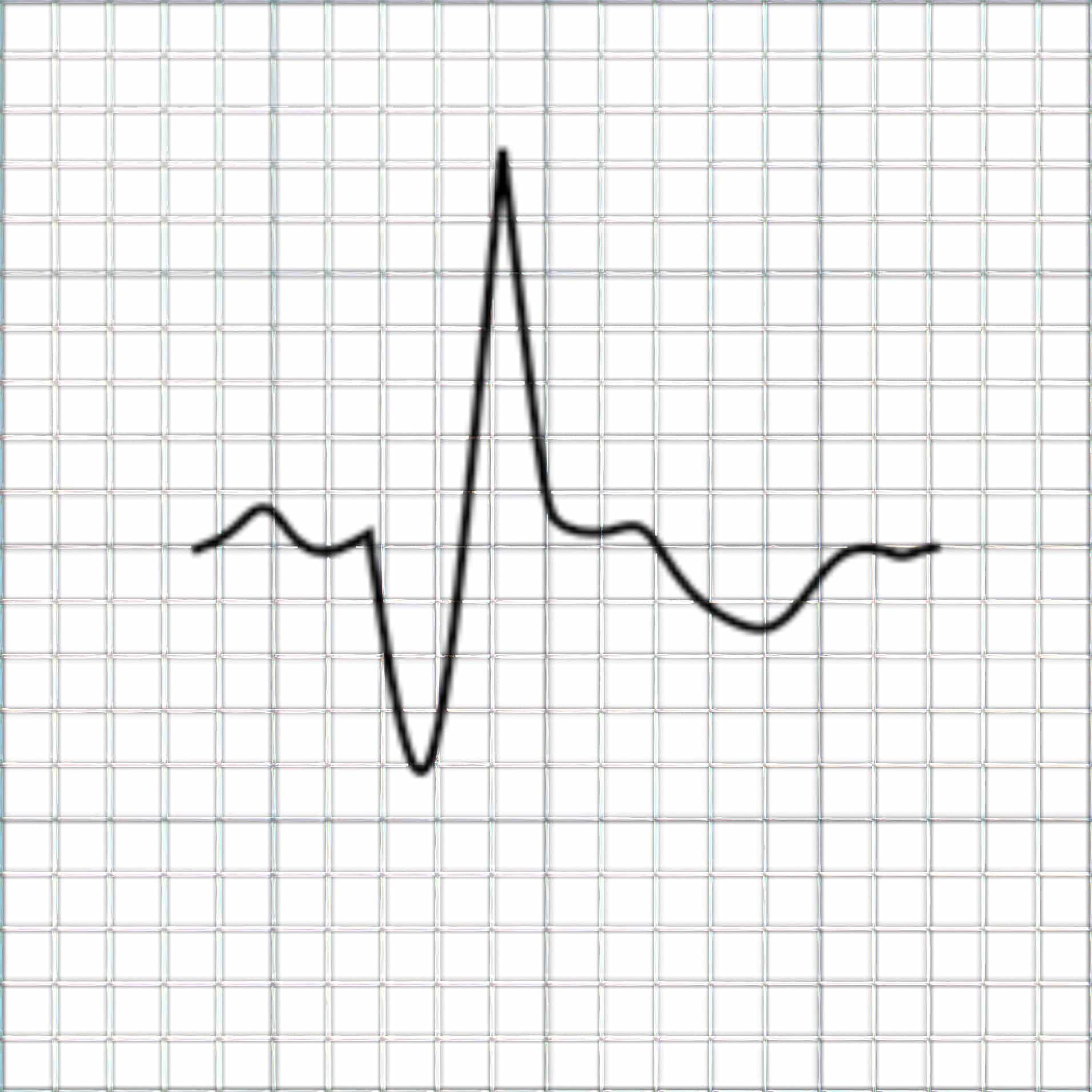 ECG depicting subacute MI.