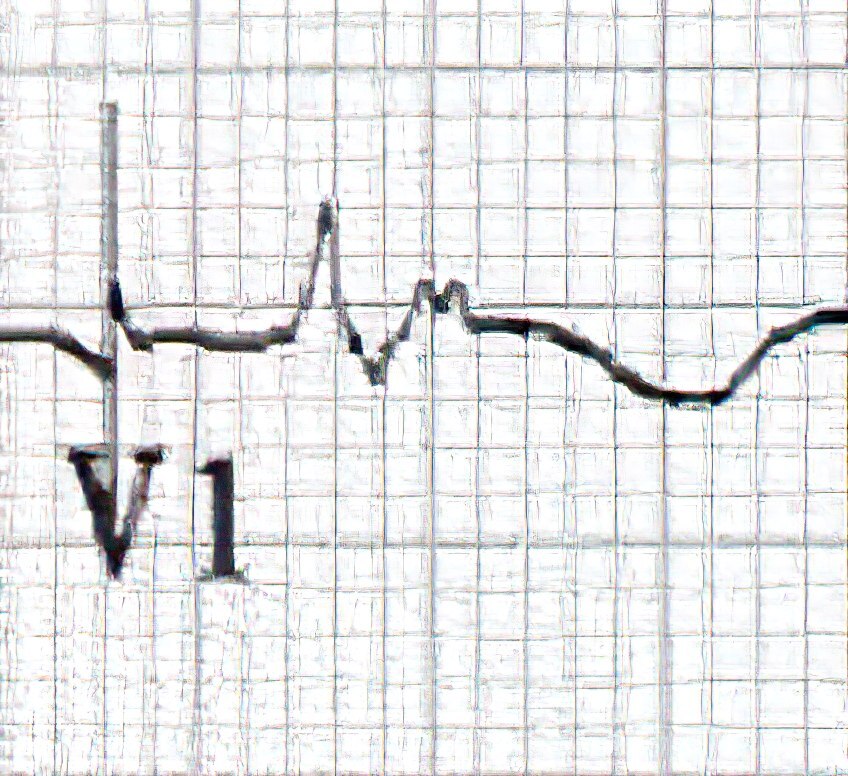 ECG tracing of patient with RVH secondary to arrhythmogenic right ventricular cardiomyopathy.