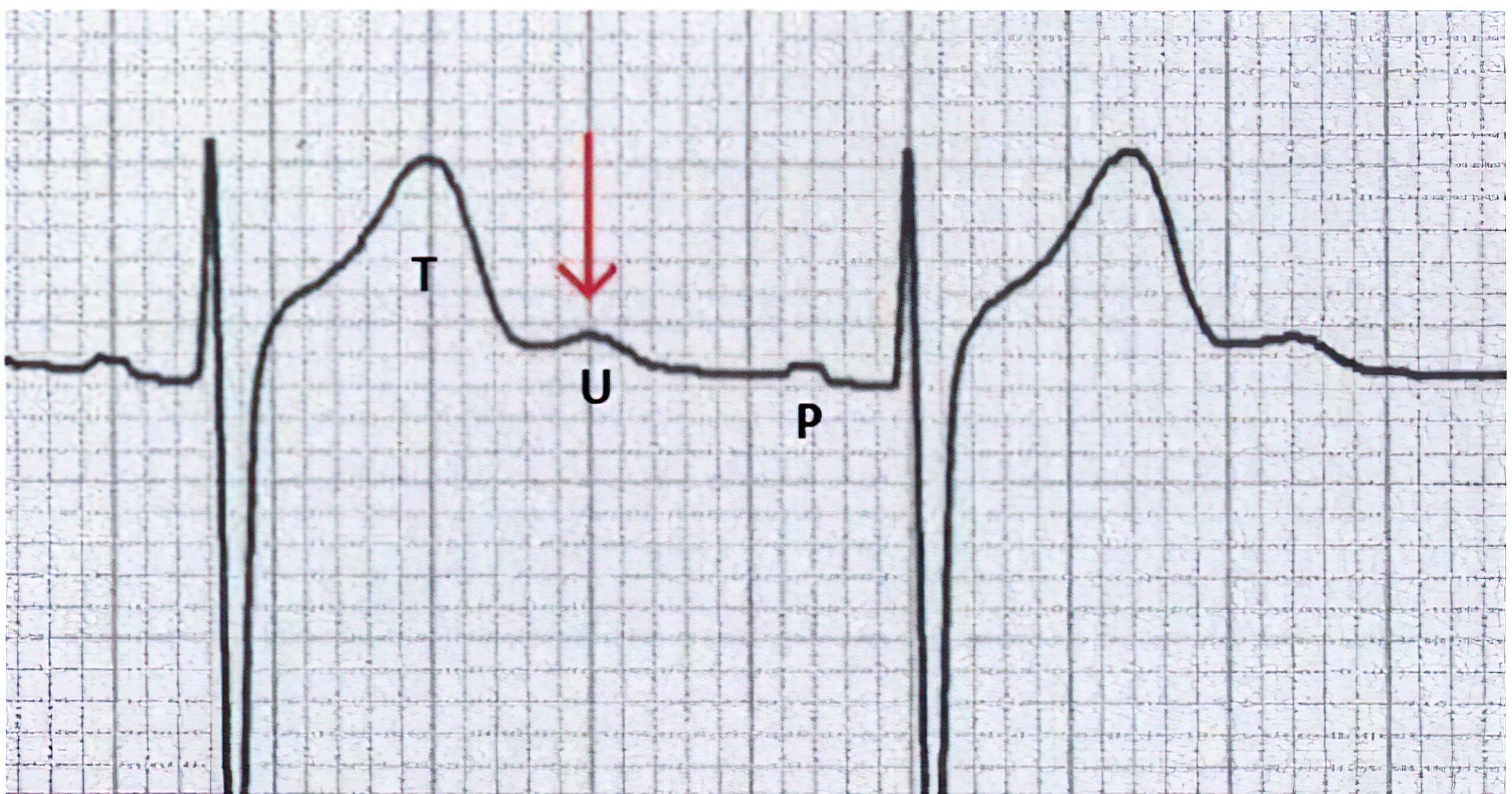 ECG tracing U wave.