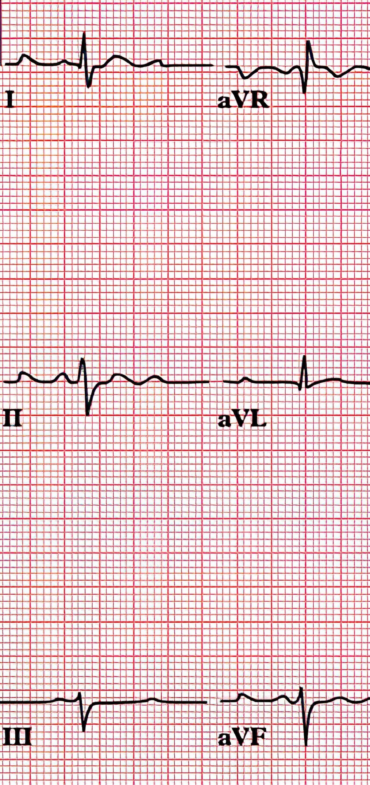 Left axis deviation ECG.