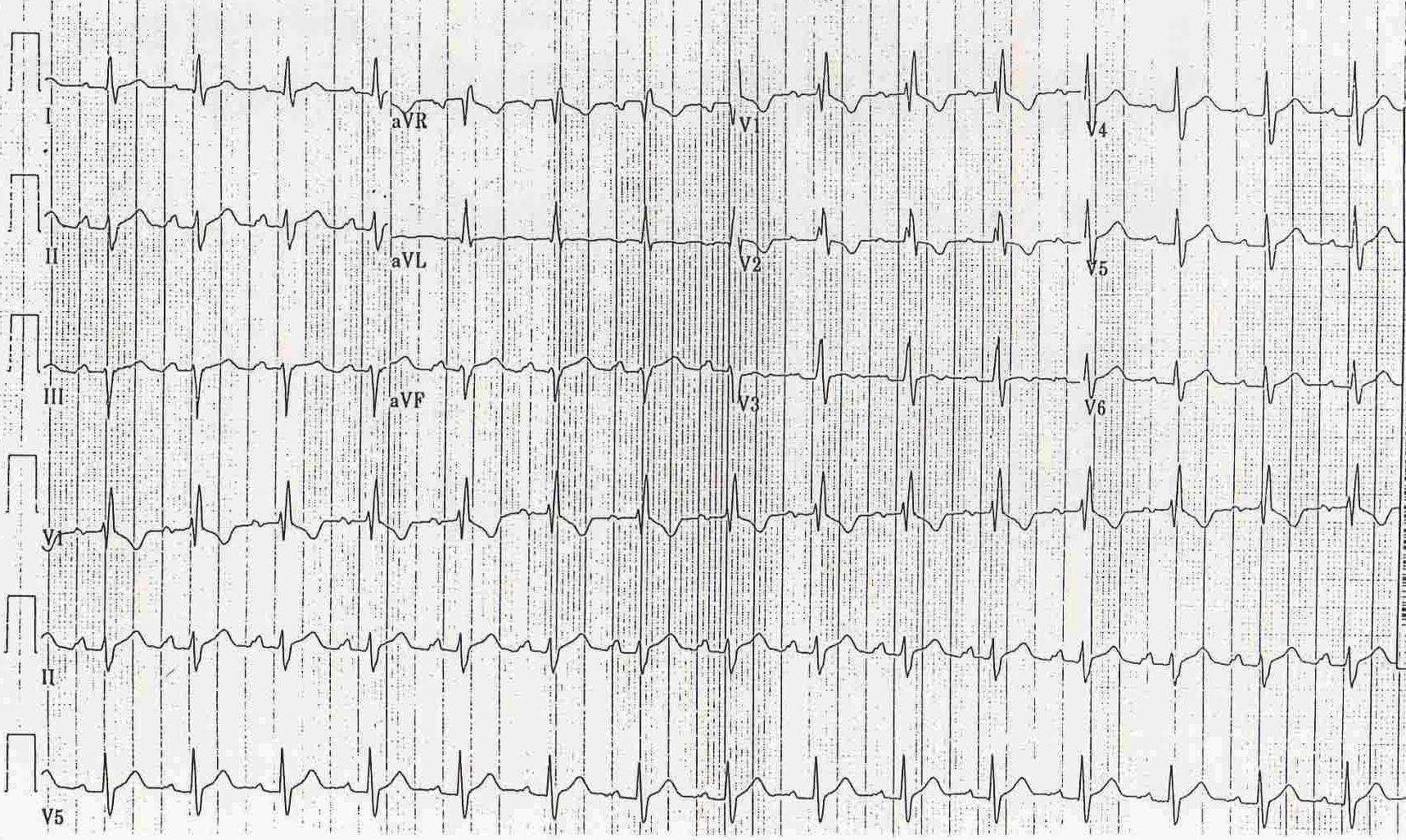 Patient with atrial septal defect ECG.