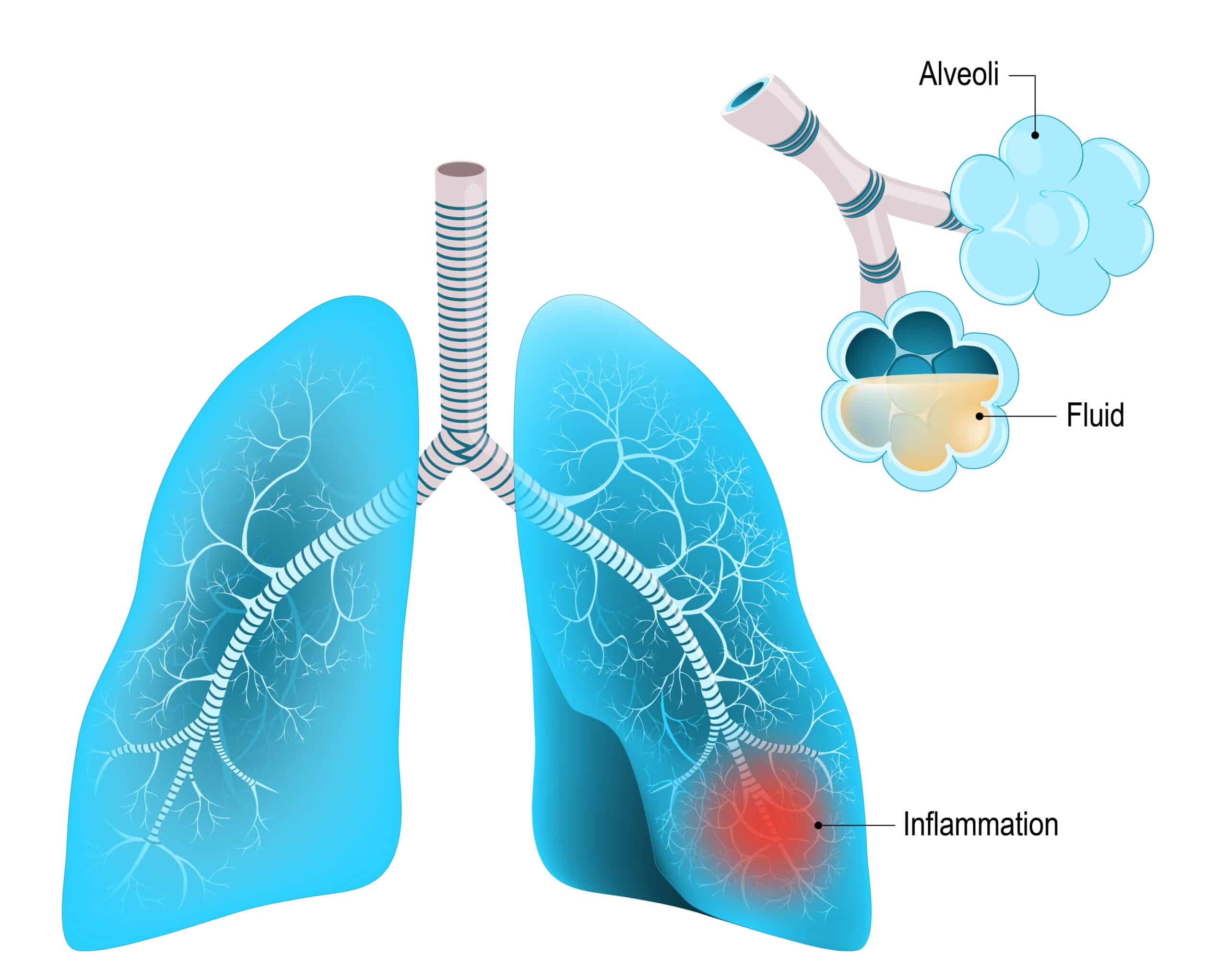 Pneumonia causes decreased lung compliance due to fluid build-up.