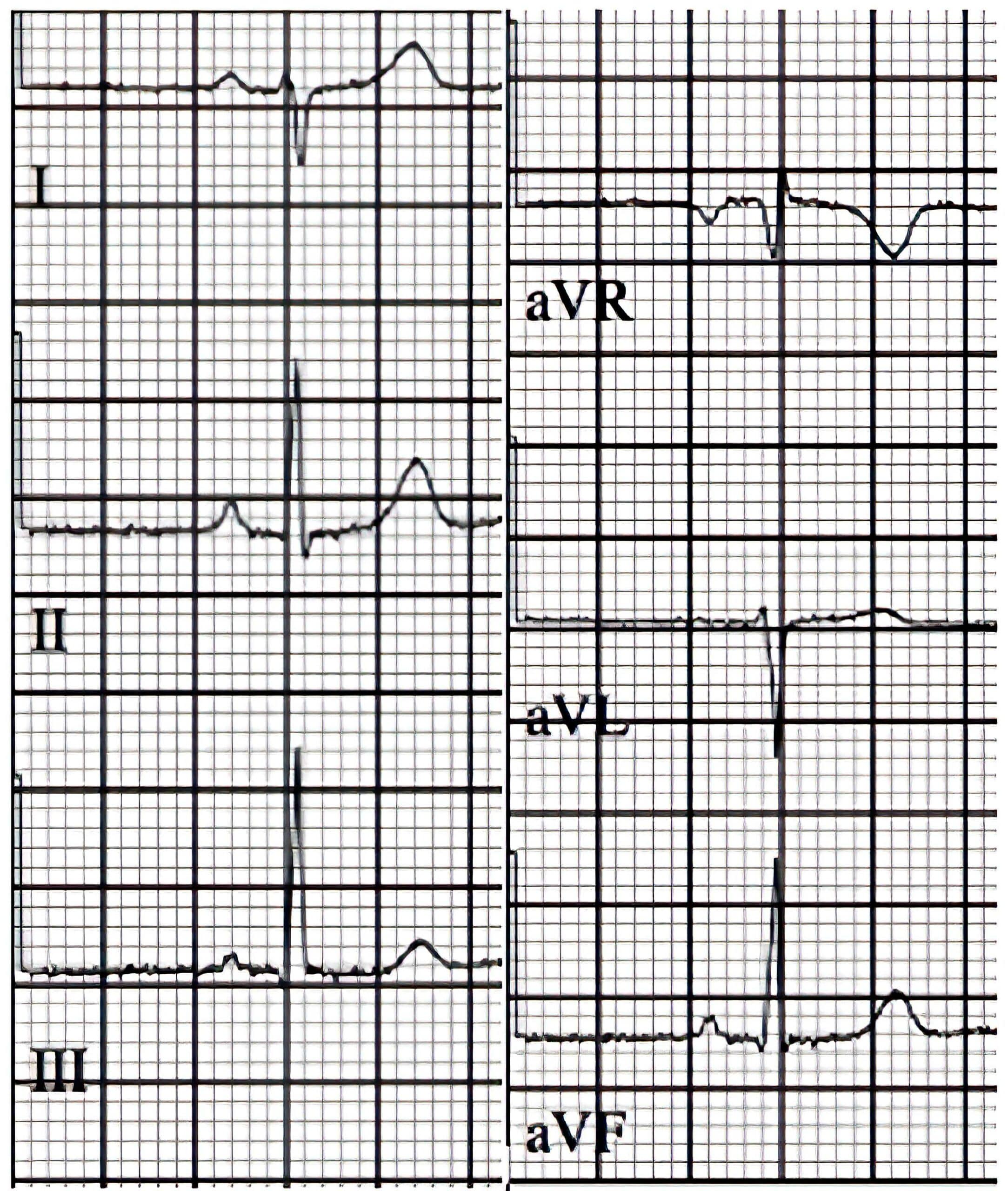 QRS frontal axis determination ECG.