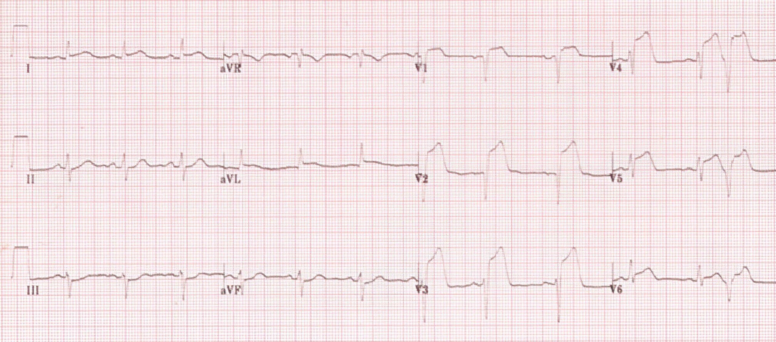 Table 2 ECG tracing.