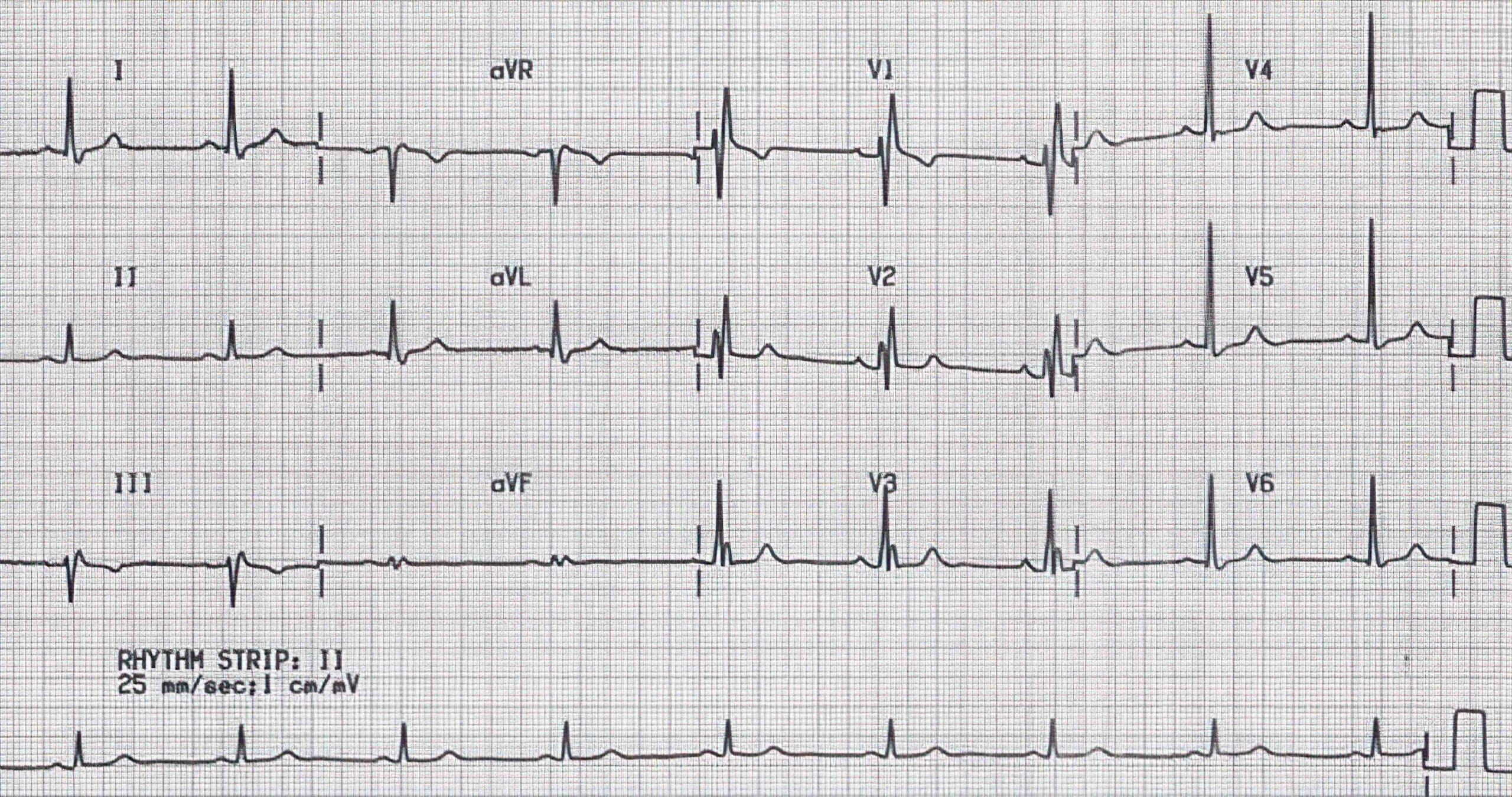 Table 3 ECG tracing.