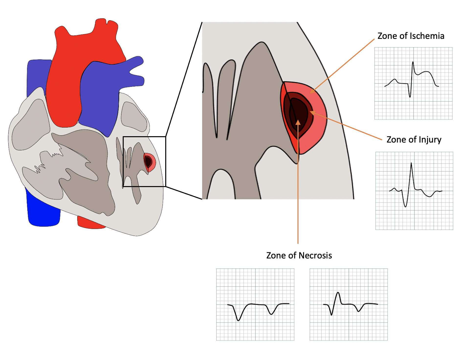 Zone of ischemia, injury, and necrosis illustration.