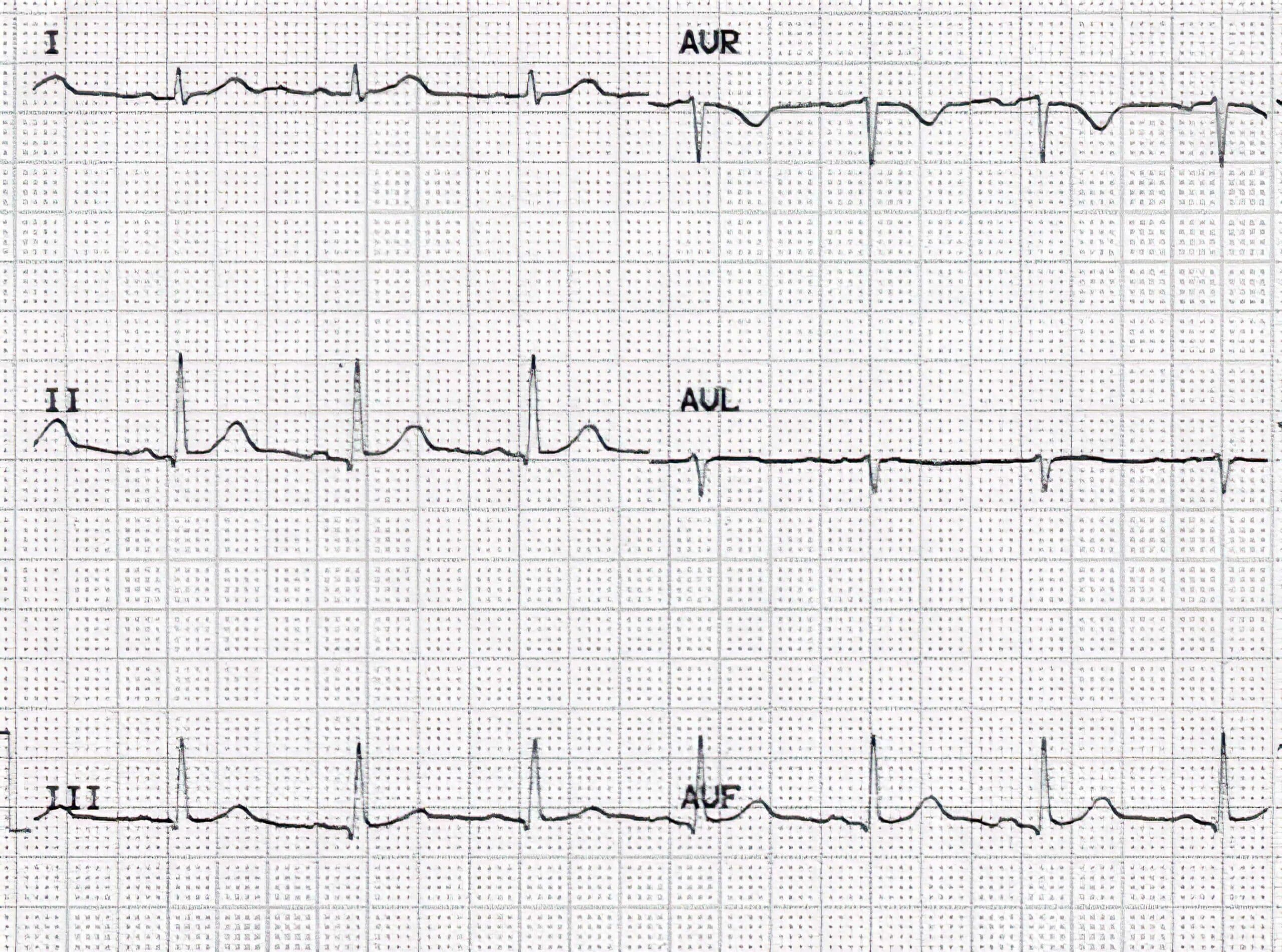 aVF positive deflection ECG.