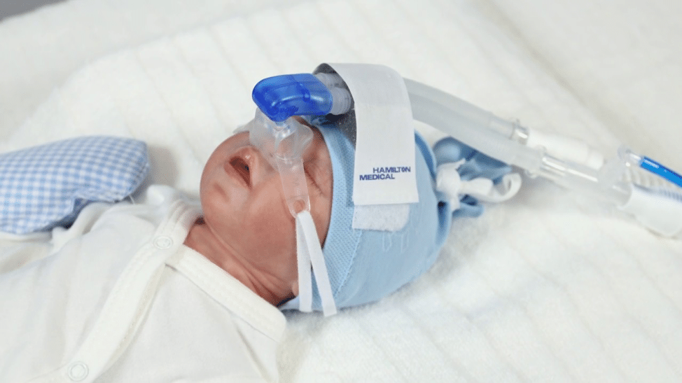 Newborn with CPAP placed over the nose.