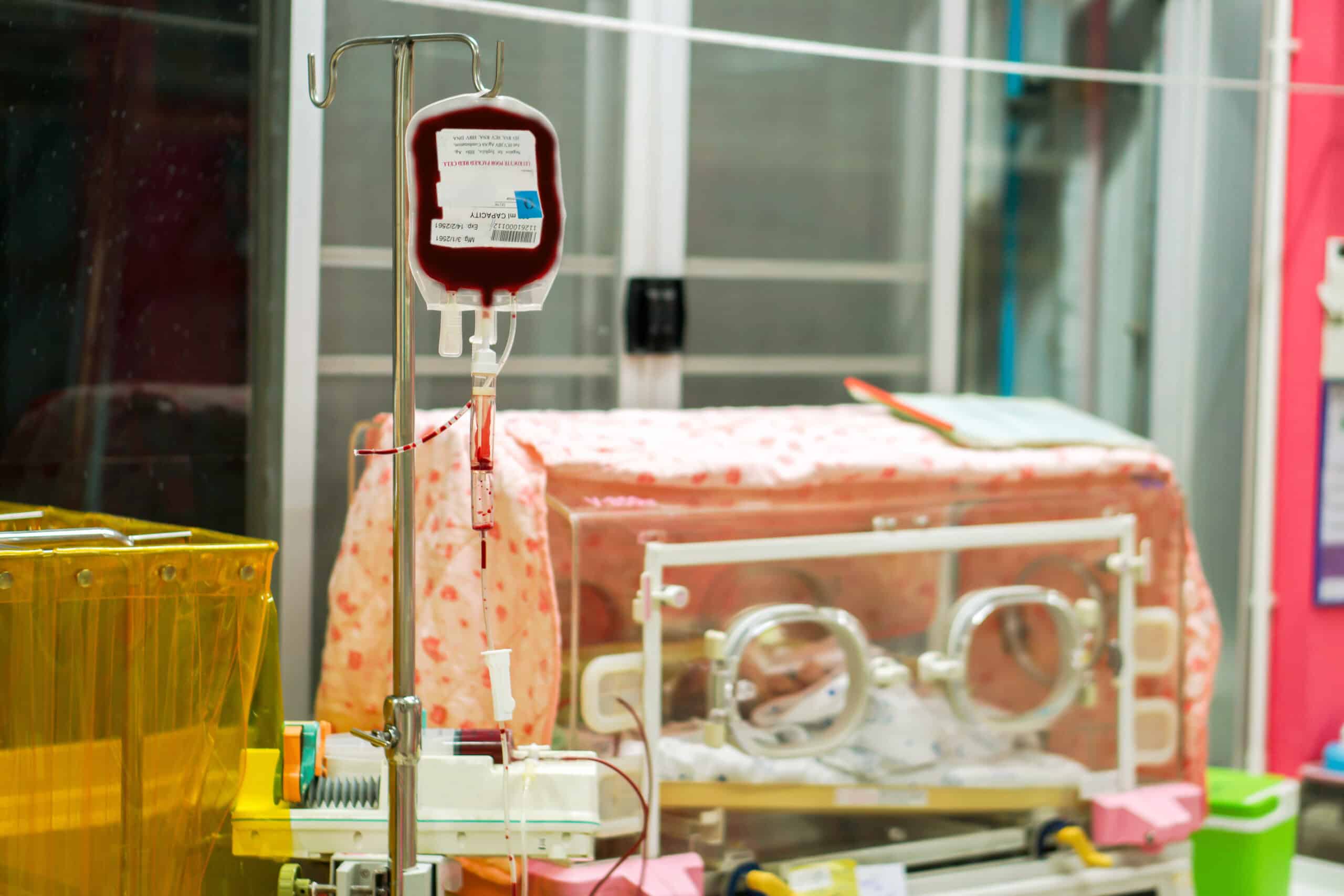 Newborn receiving blood transfusion.